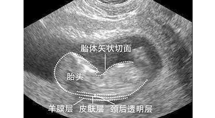 重庆代生一孩子_NT检查大揭秘！新竹市做三代试管婴儿孕期还要查NT吗？