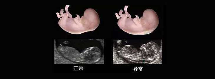 重庆代生一孩子_NT检查大揭秘！新竹市做三代试管婴儿孕期还要查NT吗？